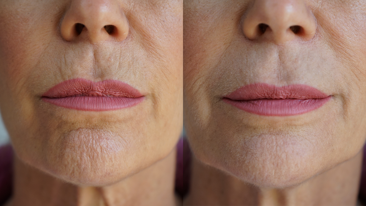 Ageless Lip & Line Filler